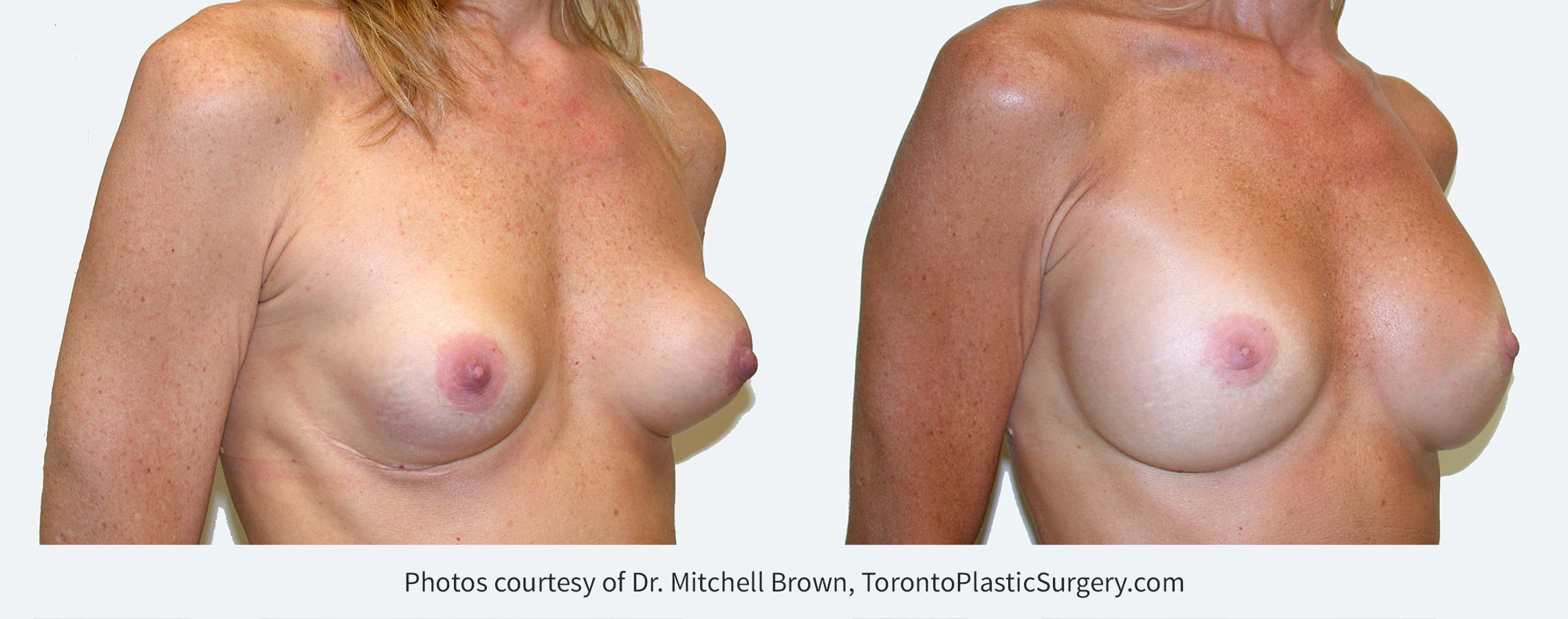 Capsular contracture (scar tissue around implants) corrected with implant removal, scar tissue removal and placement of new 275 cc silicone gel breast implants under the pectoral muscle