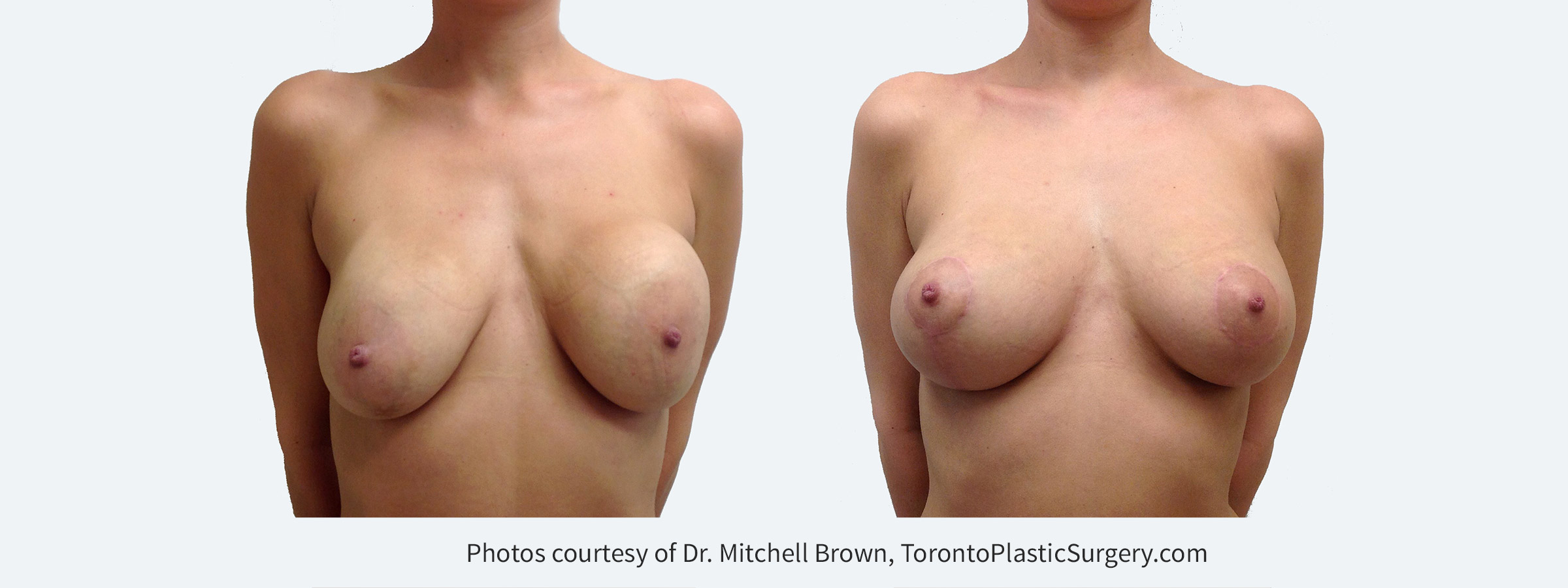 Recurrent capsular contracture on the left and implant rupture on the right treated with implant removal, scar tissue removal, replacement of new silicone gel implants under the pectoral muscle and breast lift. Before and 3 months after