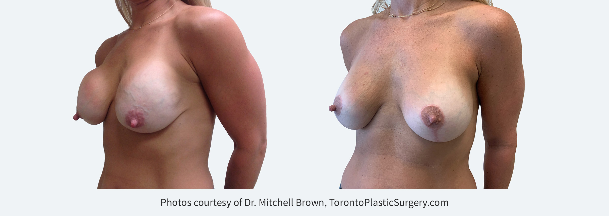Capsular contracture (scar tissue around implants) and ptosis (sagging) 13 years following breast augmentation. Corrected with removal of old implants and scar tissue, replacement of new 330cc round silicone gel implants under the muscle along with a breast lift. Before and 6 months after.