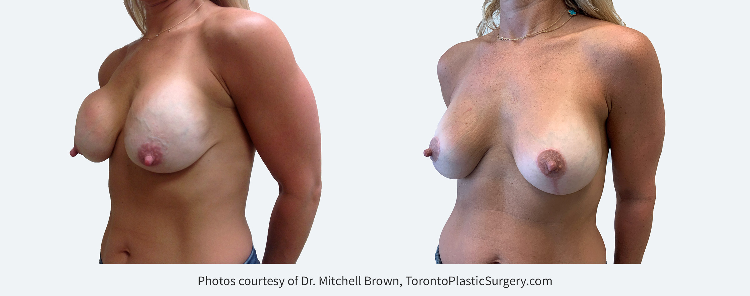 Capsular contracture fifteen years following breast augmentation with anatomic-shaped silicone gel breast implants. Treated with removal of the capsule (scar tissue) and replacement with smooth round silicone gel breast implants. Before and 6 months after.