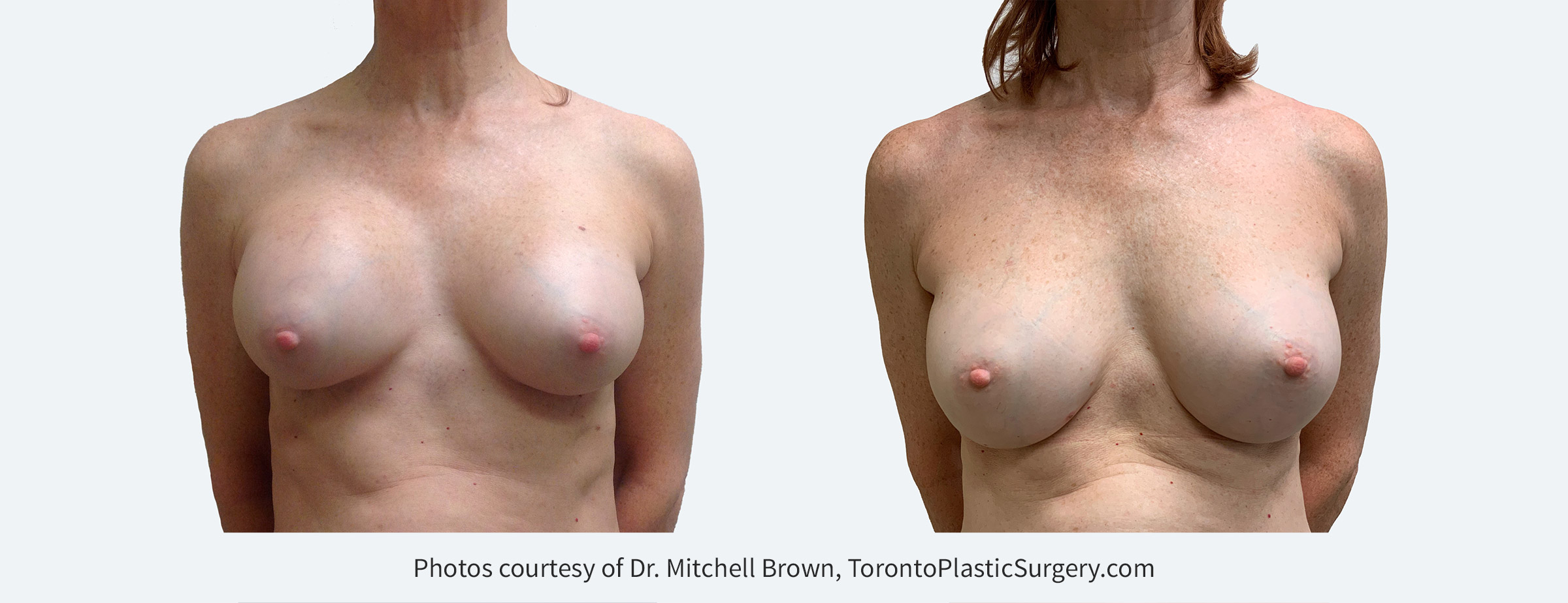 Capsular contracture fifteen years following breast augmentation with anatomic-shaped silicone gel breast implants. Treated with removal of the capsule (scar tissue) and replacement with smooth round silicone gel breast implants. Before and 6 months after.