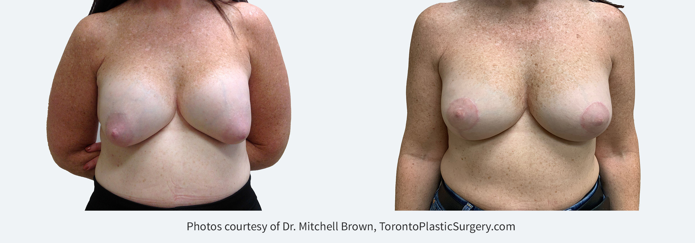 Capsular Contracture corrected with implant removal, scar tissue removal, replacement of new silicone gel 310cc implants above the pectoral muscle and breast lift. Before and 6 months after.