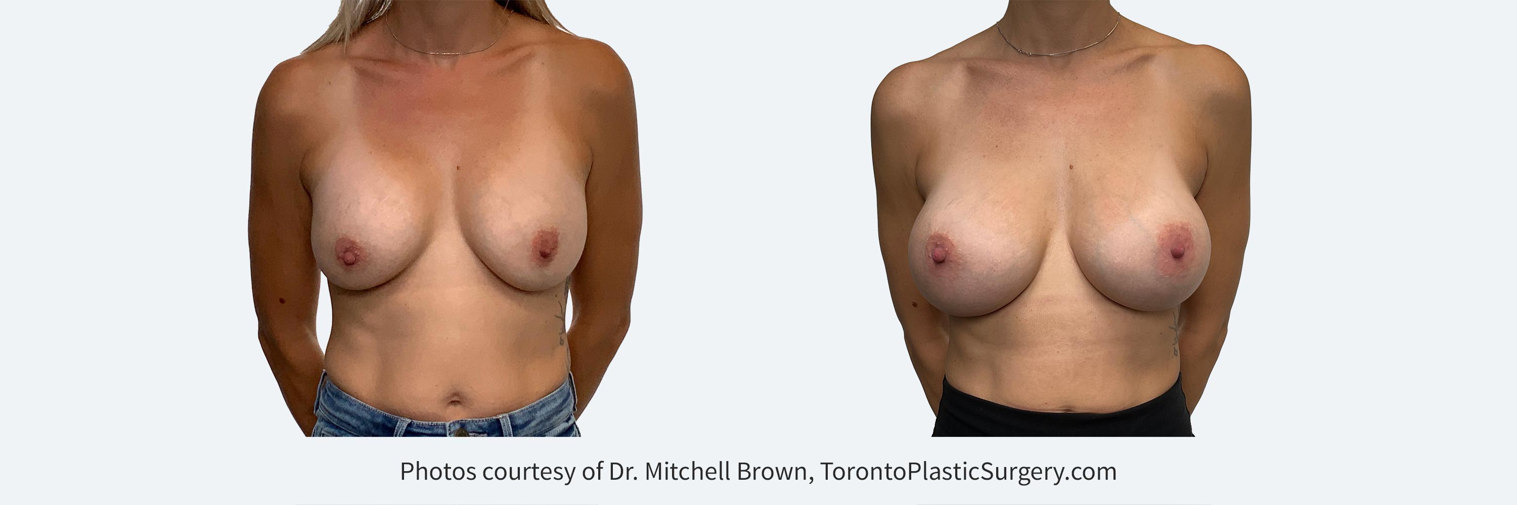 37 year female with high riding breast implants. Corrected with removal and replacement of larger 475cc implants.
