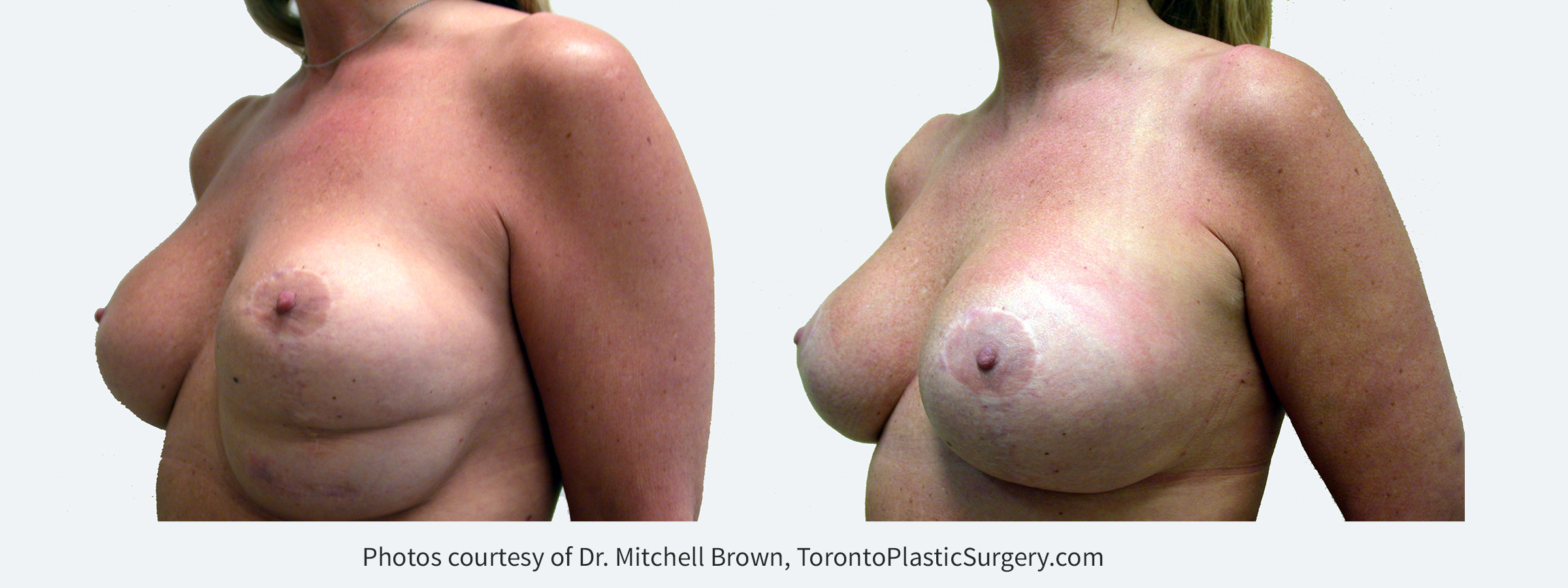Inferior malposition of the left implant (implant too low) due to excessive release of the inframammary fold following breast augmentation and breast lift. The patient had several failed corrections. Left implant position corrected with internal sutures of the fold and insertion of an internal support matrix. Before and 6 months after