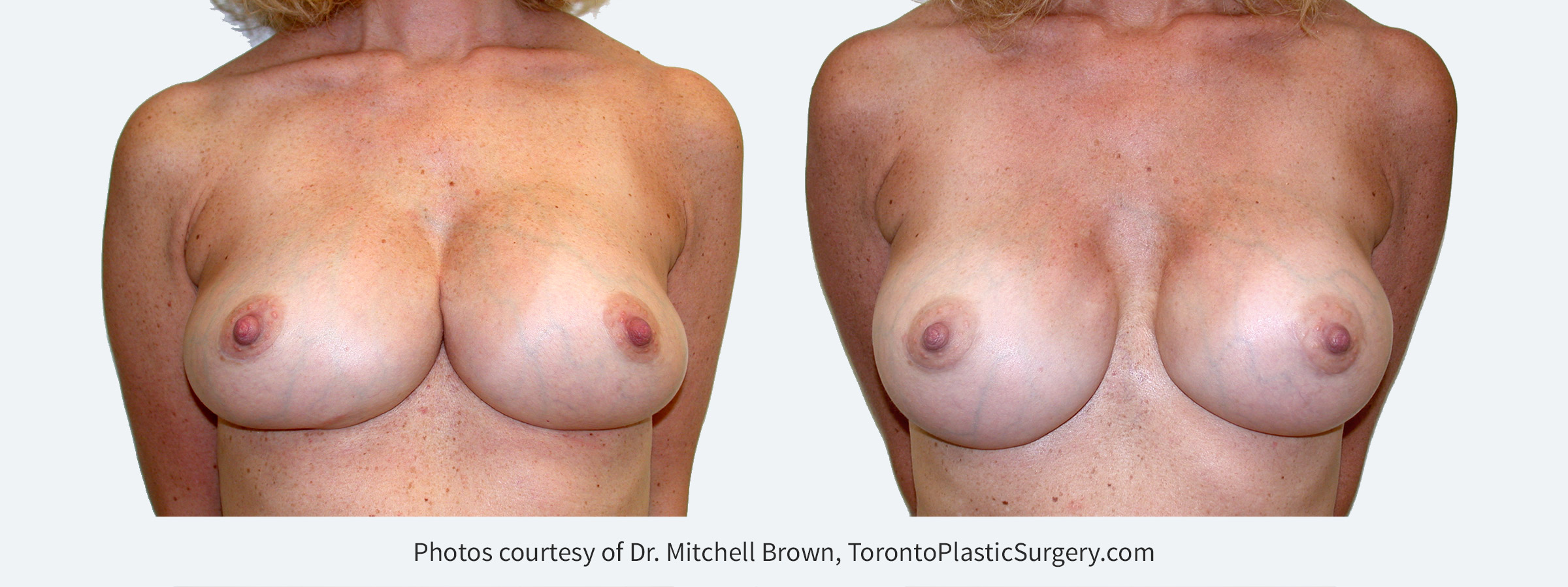 Synmastia (implants too close together). Corrected by placing smaller and narrower implants in a new pocket under the pectoral muscle along with reinforcement of  the medial breast implant pocket. Before and 6 months after