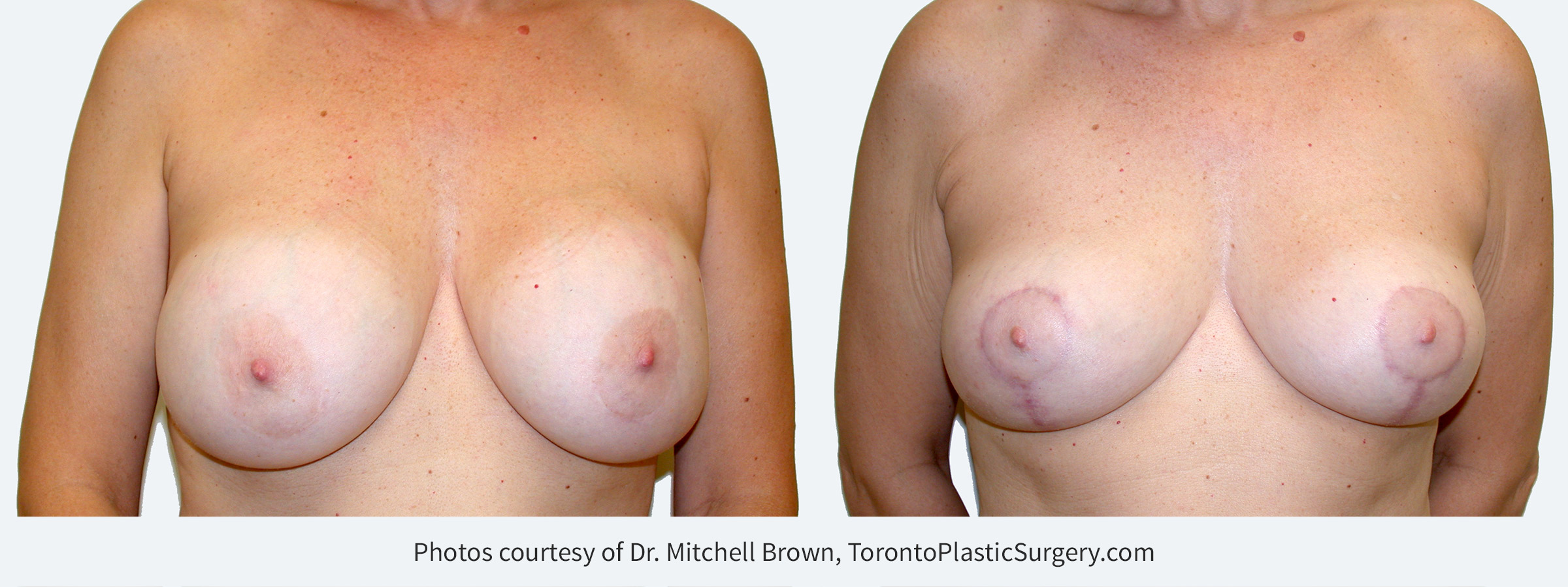 Recurrent capsular contracture treated with implant removal and reshaping of the breasts with a breast lift and fat grafting. Before and 6 months after