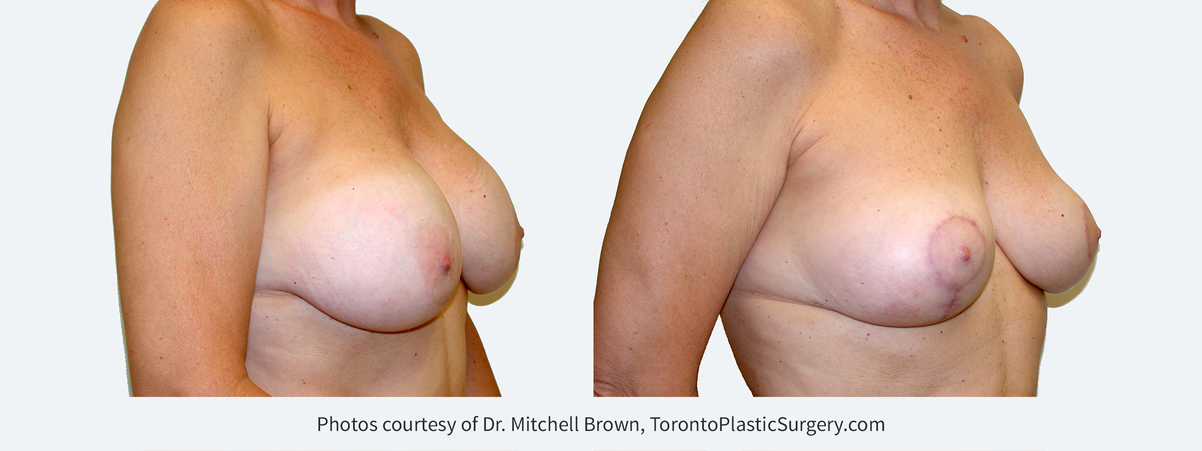Recurrent capsular contracture treated with implant removal and reshaping of the breasts with a breast lift and fat grafting. Before and 6 months after