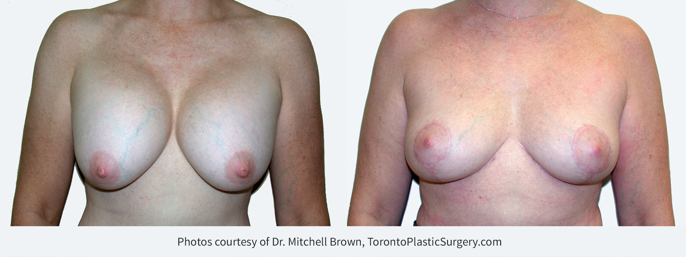 Recurrent capsular contracture and sagging of the breast treated with implant removal and reshaping of the breasts with a breast lift and fat grafting. Before and 6 months after.