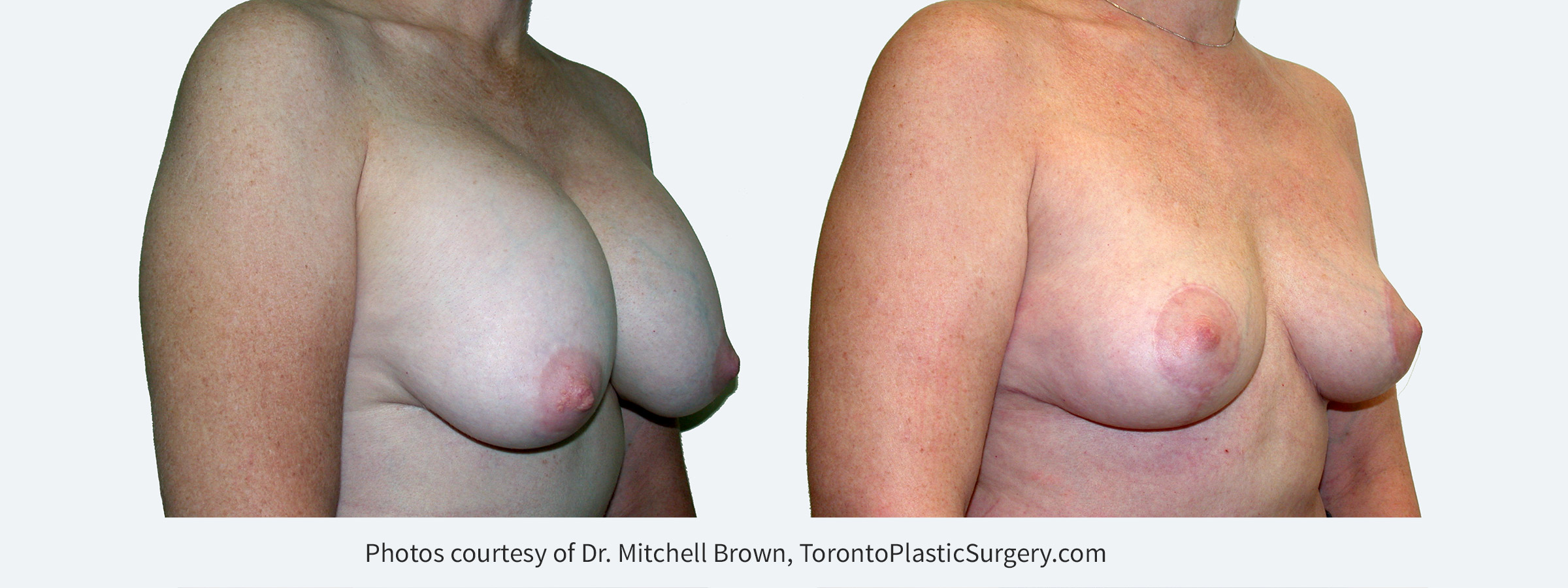 Recurrent capsular contracture and sagging of the breast treated with implant removal and reshaping of the breasts with a breast lift and fat grafting. Before and 6 months after.