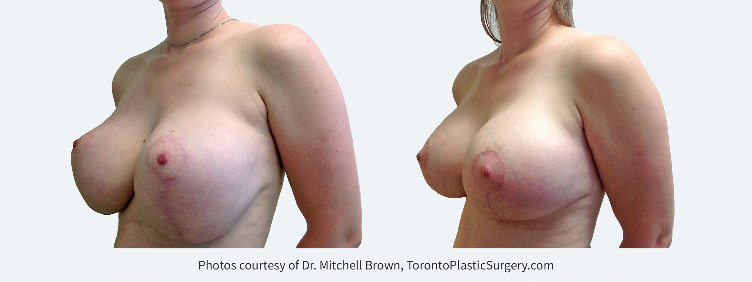 Large implants with inadequate breast lift. This has resulted in stretching of the breast skin and nipples placed too high. Correction with small downsizing of implants and revision of the breast lift including internal support for the implant position. Before and 4 months after