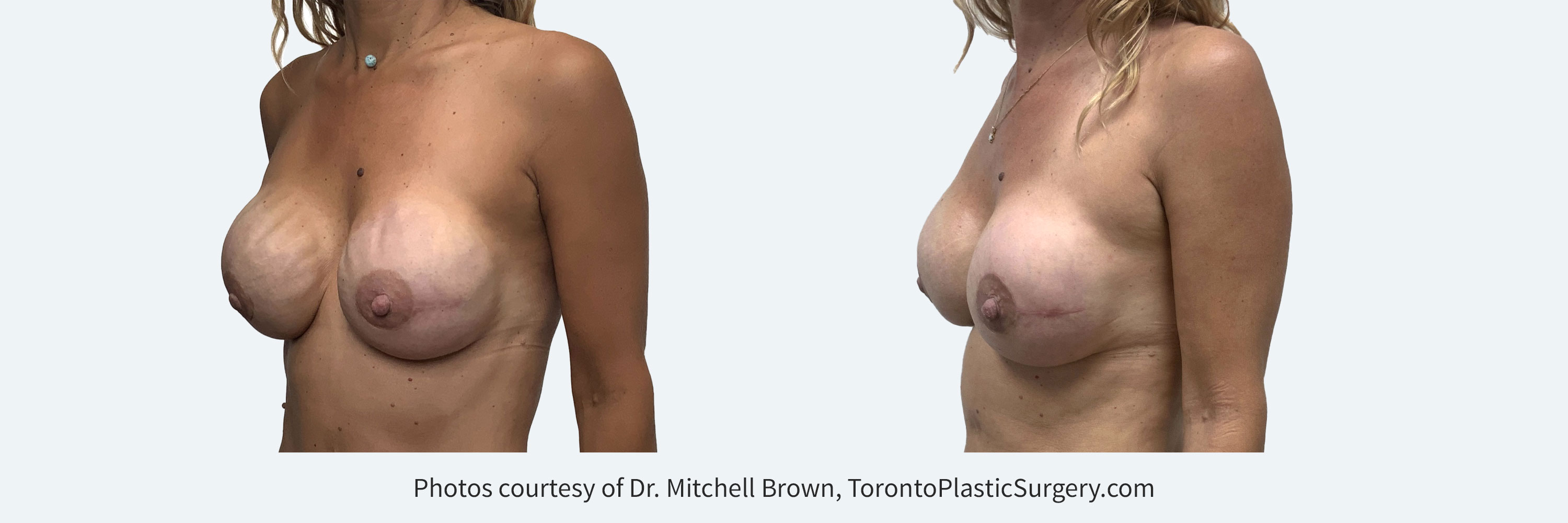 Nipple-sparing mastectomy reconstructed using breast implants with severe visible rippling. Corrected with a combination of more highly cohesive implants, fat grafting and insertion of an internal sling for implant support. Before and 6 months after.